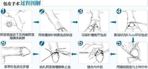 韩式绣雕包皮包茎整形术是一种完全符合生殖卫生及疾病预防,保健的